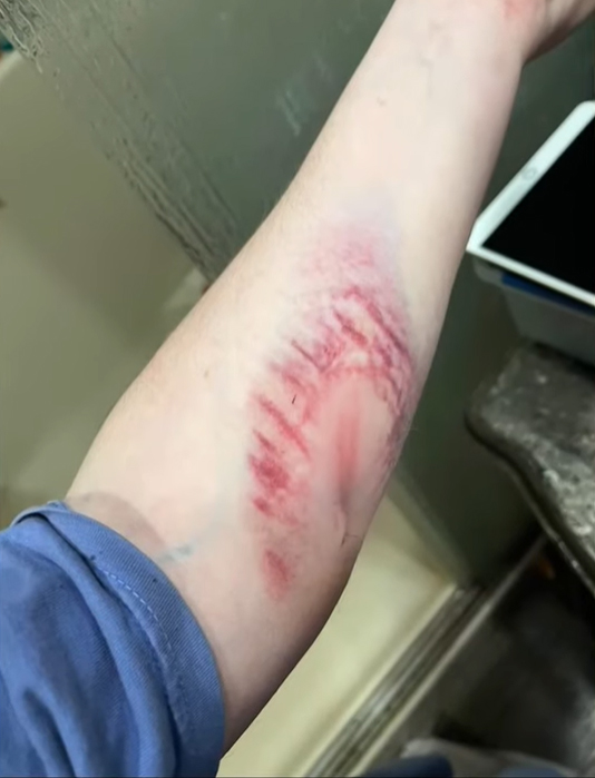 Vết bầm tím trên cánh tay nữ tài xế do logo tự gắn trên vô-lăng đập trúng sau khi túi khí bung. Ảnh: First Coast News